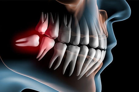Lake Houston Endodontics | Tooth Extraction in Humble, TX: When Removal Protects Your Long-Term Health Lake Houston Endodontics | Tooth Extraction in Humble, TX: When Removal Protects Your Long-Term Health