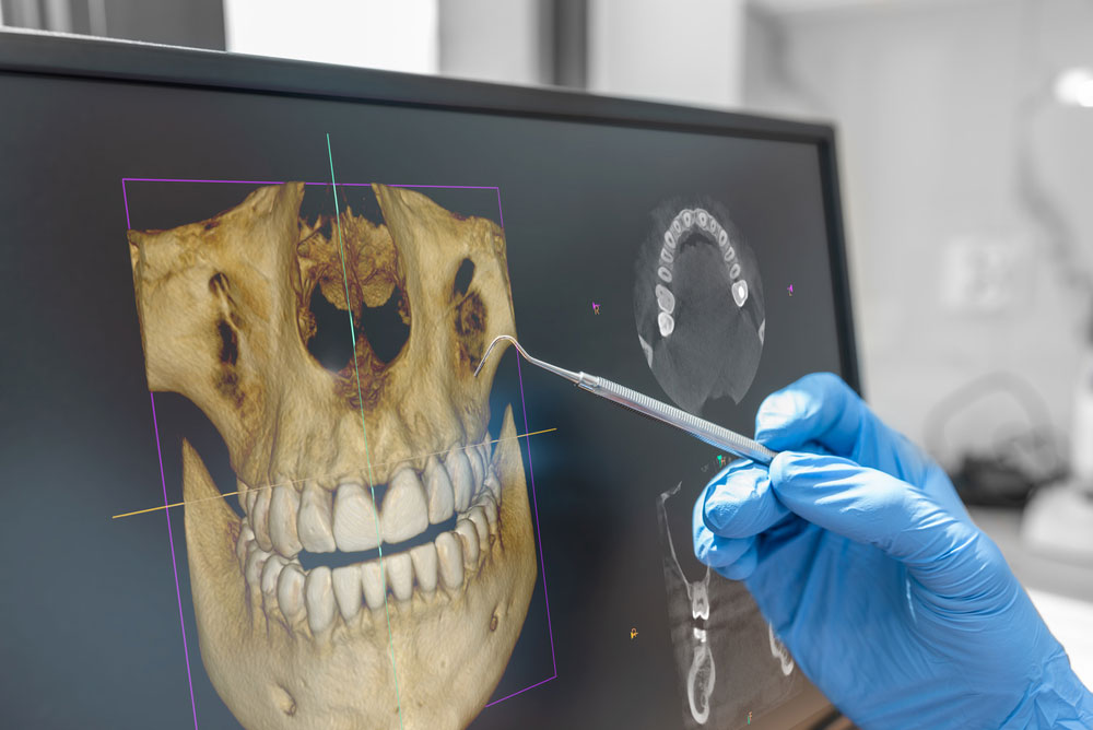 Lake Houston Endodontics | CBCT Imaging for Root Canal Treatment: How 3D Scans Reveal Hidden Problems Lake Houston Endodontics | CBCT Imaging for Root Canal Treatment: How 3D Scans Reveal Hidden Problems
